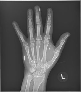Abbildung 1: Diverse Mikrochips als Implantate in einer Hand – schon heute kann man auf diesem Weg einigermaßen sicher bezahlen, sind sich Fans der Technologie einig. Quelle: LordSethos, CC BY-SA 4.0, Wikipedia.org